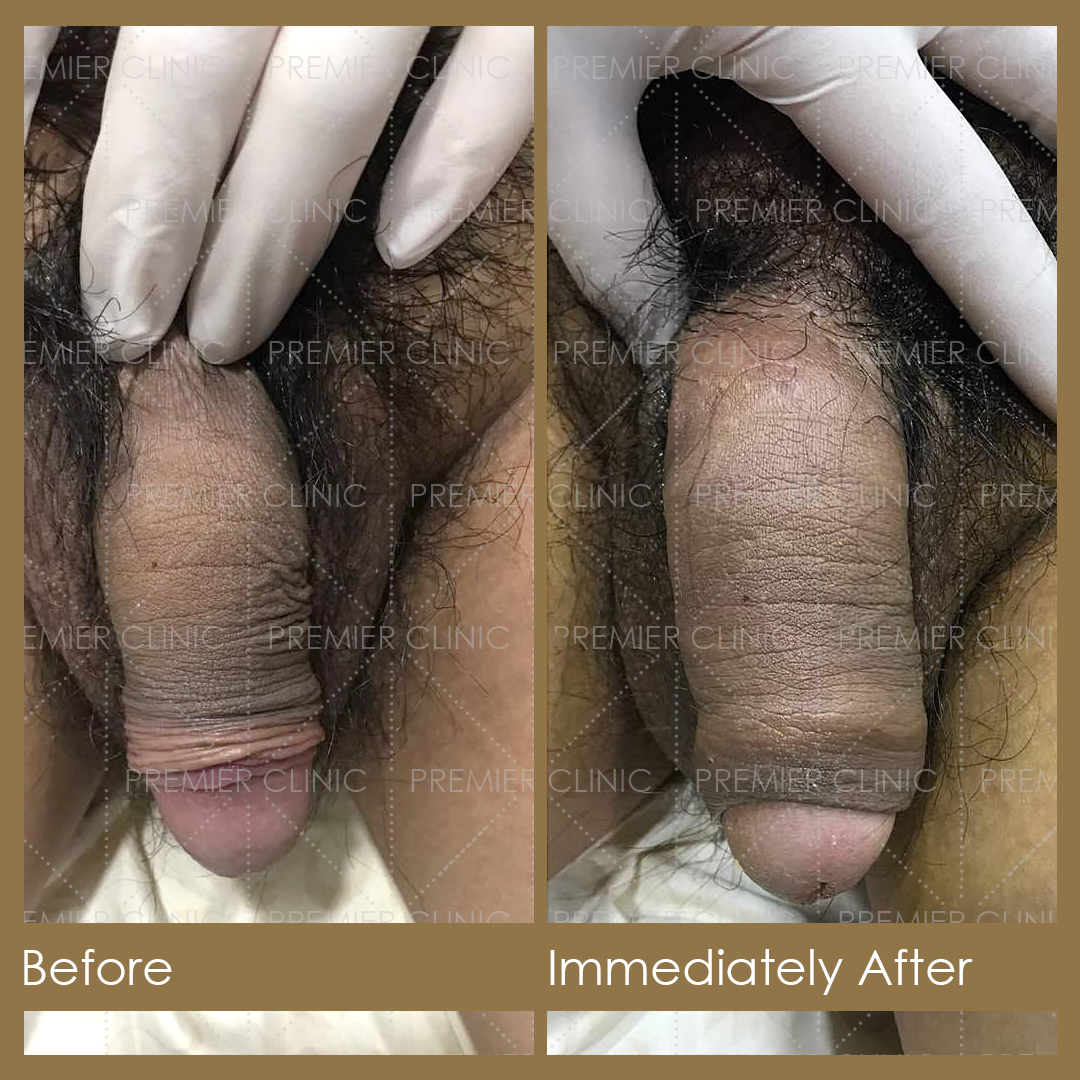 1080 X 1080 Premier Penis Enlargement Filler Before & After 05