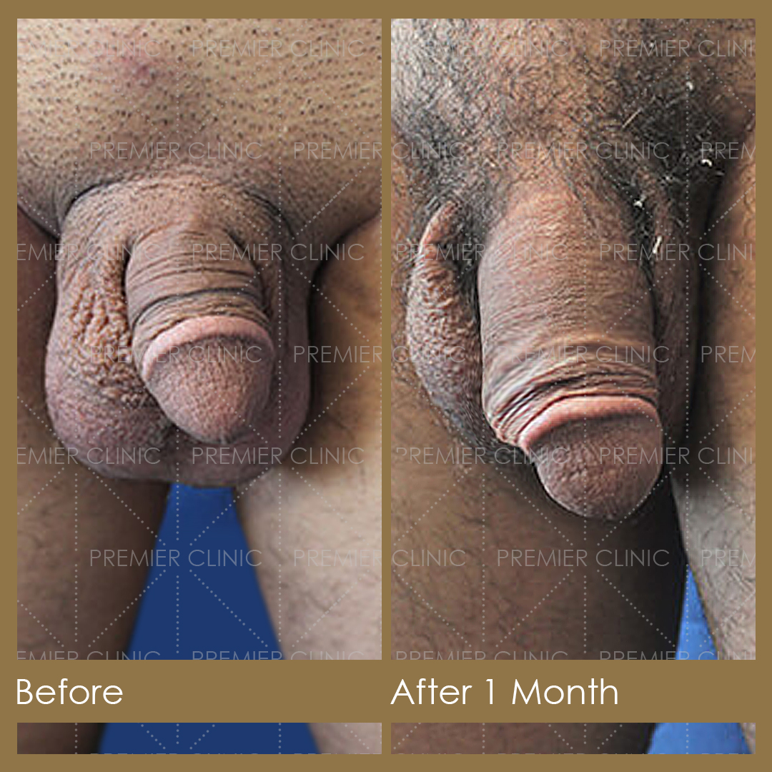 1080 X 1080 Premier Penis Enlargement Filler Before & After 06