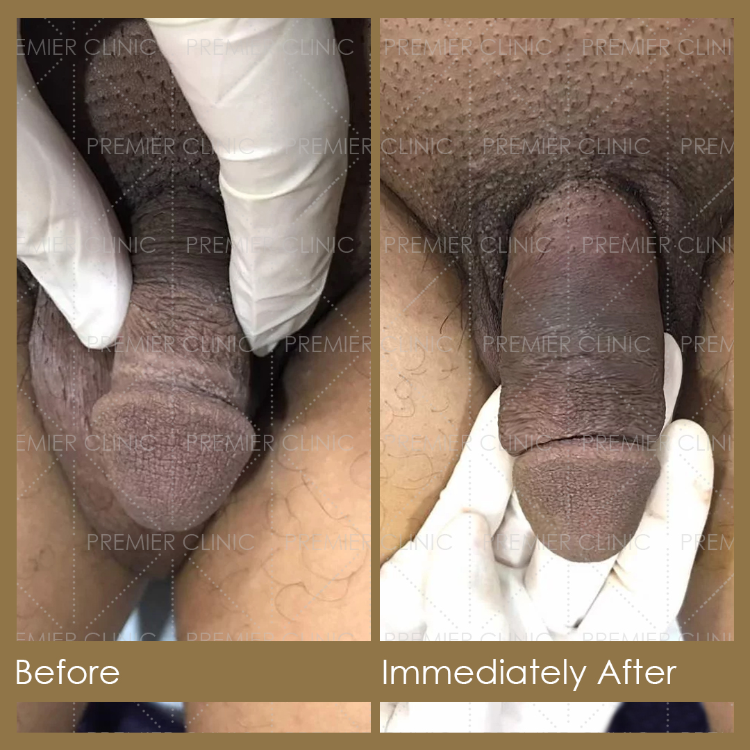 1080 X 1080 Premier Penis Enlargement Filler Before & After 10 Premier Penis Enlargement Filler Before & After