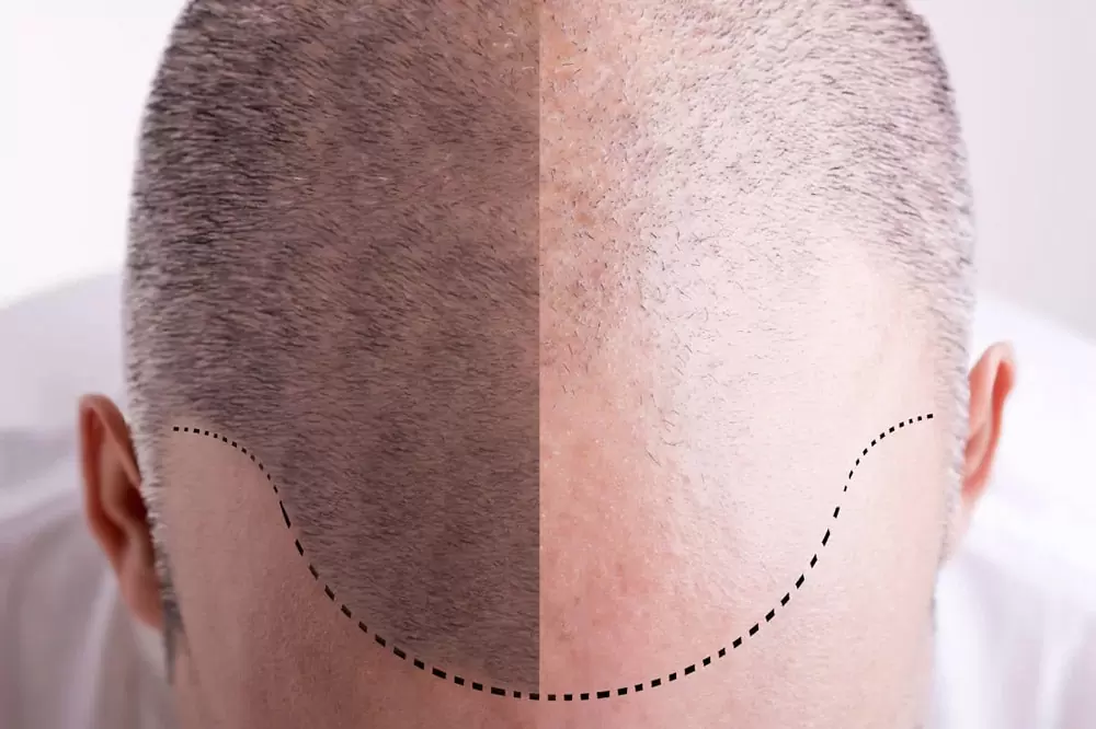 hair implants vs hair planting