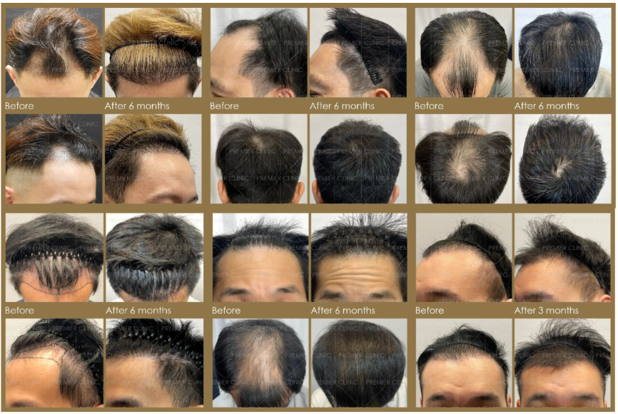 Before after photo