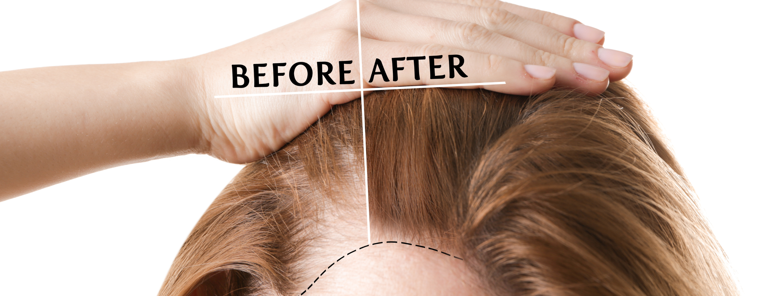 Hair Loss 4