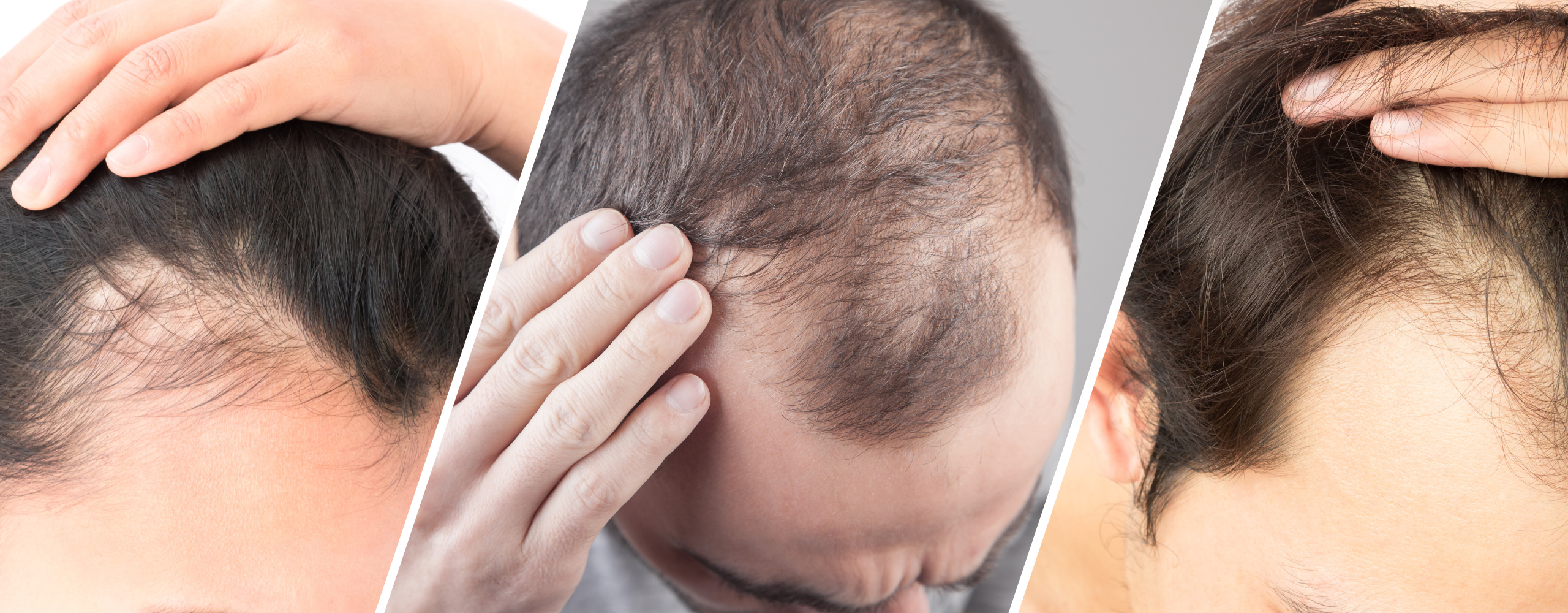 Hair Loss 7